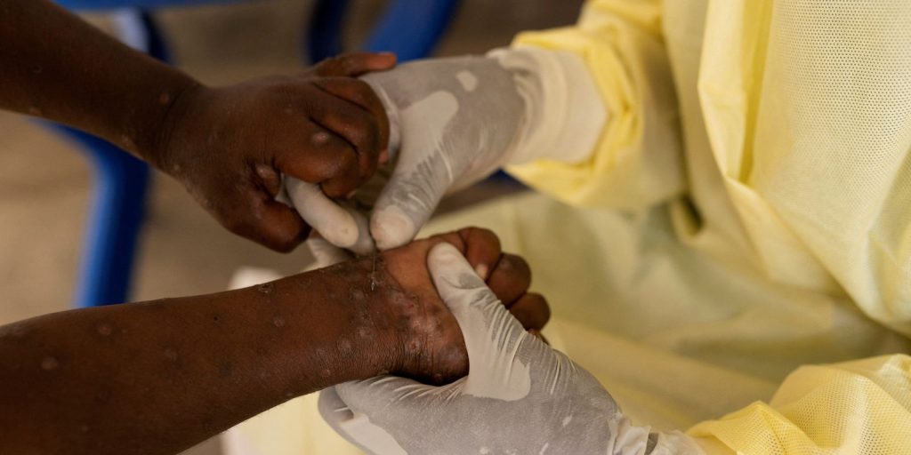 brasil-registra-88-casos-de-mpox-em-2026;-saiba-como-evitar-a-doenca