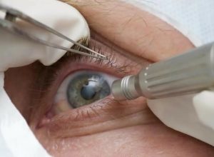 cirurgia-que-altera-cor-do-olho-tem-uso-restrito-para-pessoas-cegas
