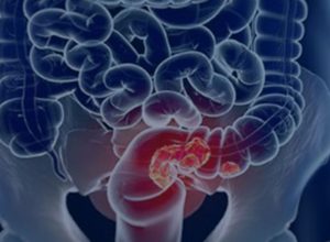 estudo-projeta-aumento-de-36%-em-mortes-por-cancer-colorretal-ate-2040