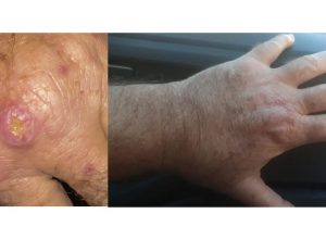 especialistas-alertam-para-a-falta-de-informacao-sobre-a-leishmaniose