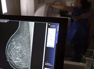 periodicidade-de-mamografias-divide-medicos-e-autoridades-de-saude