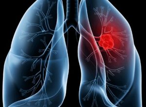 saiba-o-que-e-adenocarcinoma-pulmonar,-cancer-que-atinge-o-papa