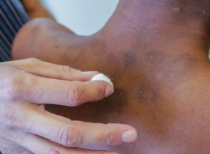 ia-criada-por-brasileiros-avalia-risco-de-agravamento-da-hanseniase